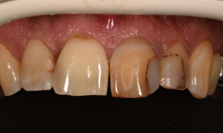Close up of mouth before cosmetic crown and fillings, fontana ca