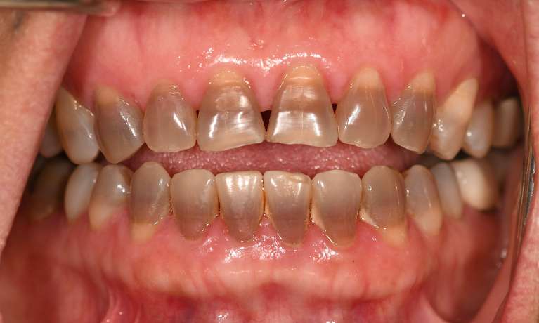 Cosmetic-Crowns-Before-Image