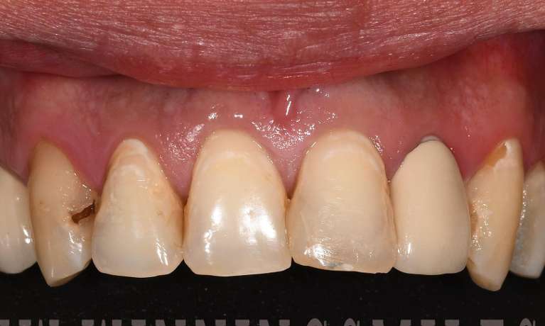 Close up of teeth before crowns and veeners, fontana ca