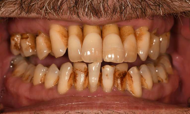 Mouth before full mouth rehabilitation, fontana ca