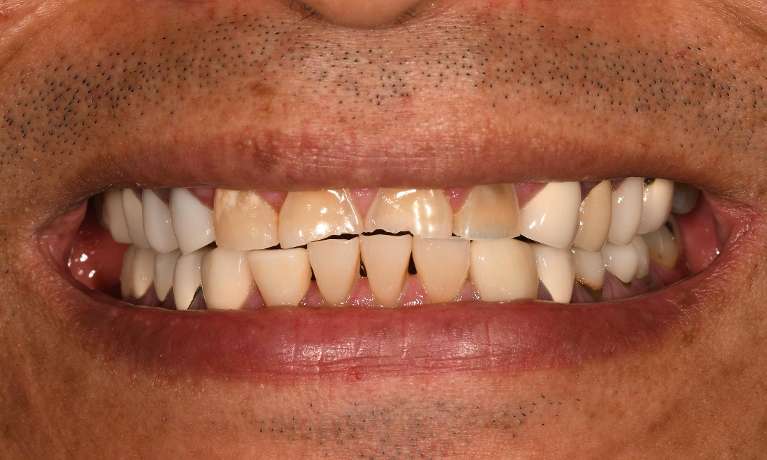 Close up of teeth before full mouth rehabilitation with veneers and crowns, fontana ca
