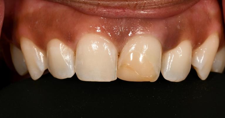 Before Porcelain Veneer in Winning Smiles
