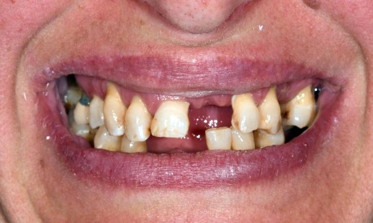 Dental-Implant-Tooth-Replacement-Before-Image