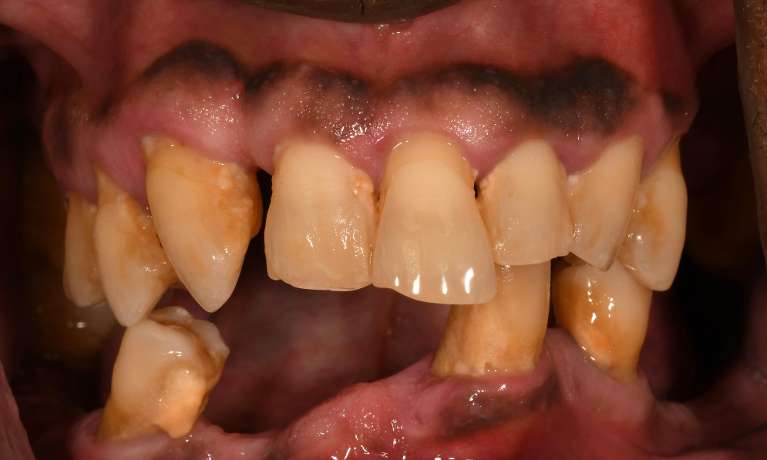 Quality-Dentures-with-some-implants-Before-Image