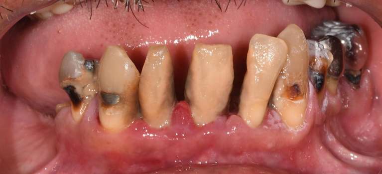 Rehabilitation-of-the-lower-arch-with-3-implants-and-an-premium-overdenture-Before-Image