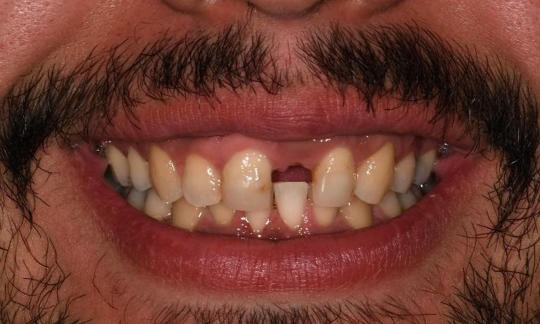 Before Dental Implant in Winning Smiles Fontana CA