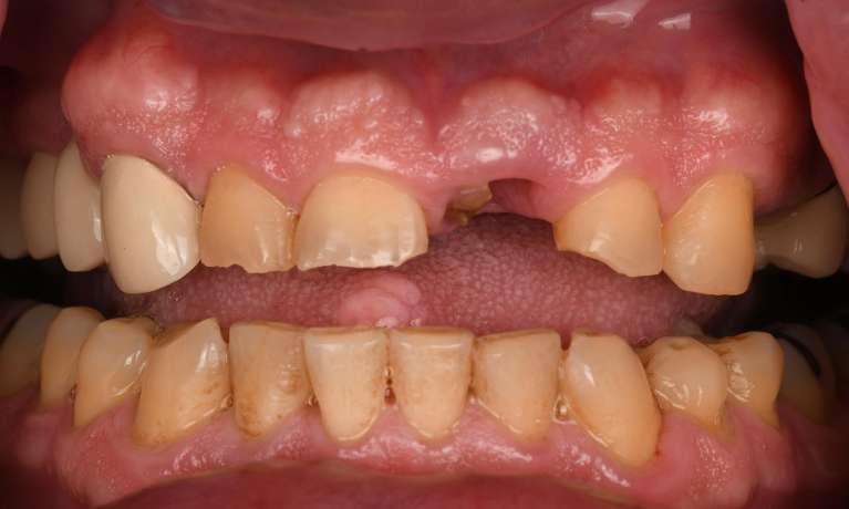 Close up of mouth before smile transformation, fontana ca